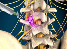Medial Branch Block