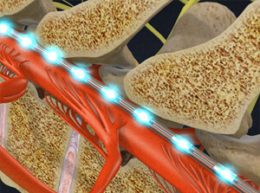 spinal cord stimulation