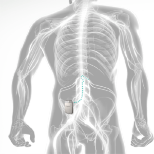 DRG Stimulation for Amputee Patients