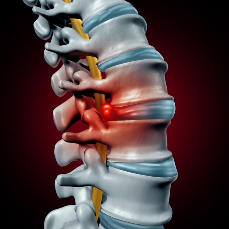 Could You Have a Herniated Disk? Symptoms and Diagnosis