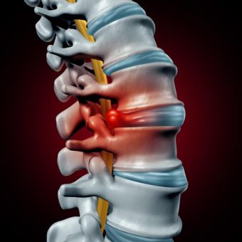 Herniated Disk