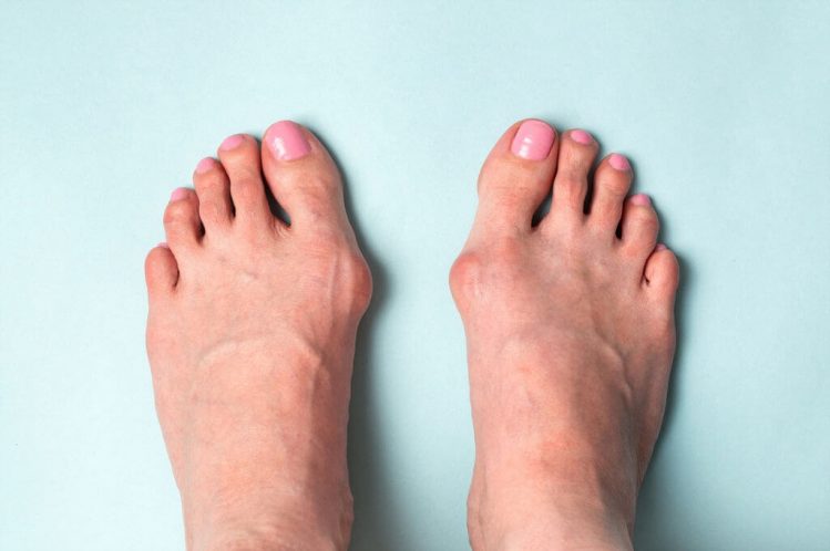 hallux rigidus, arthritis of the big toe