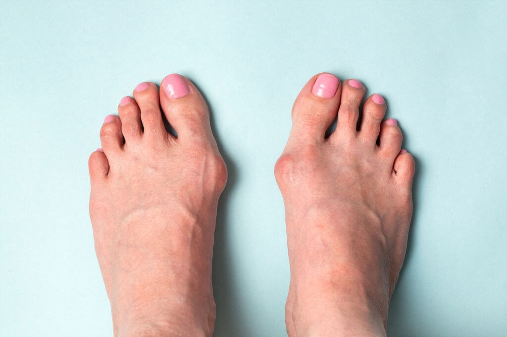 arthritic symptoms in big toe