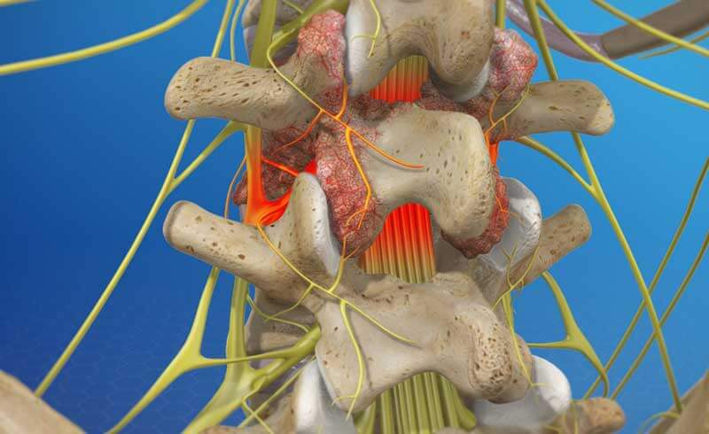 Spinal Osteoarthritis