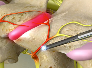 Radiofrequency Ablation (RFA)