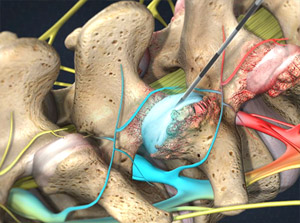 Facet Joint Injection