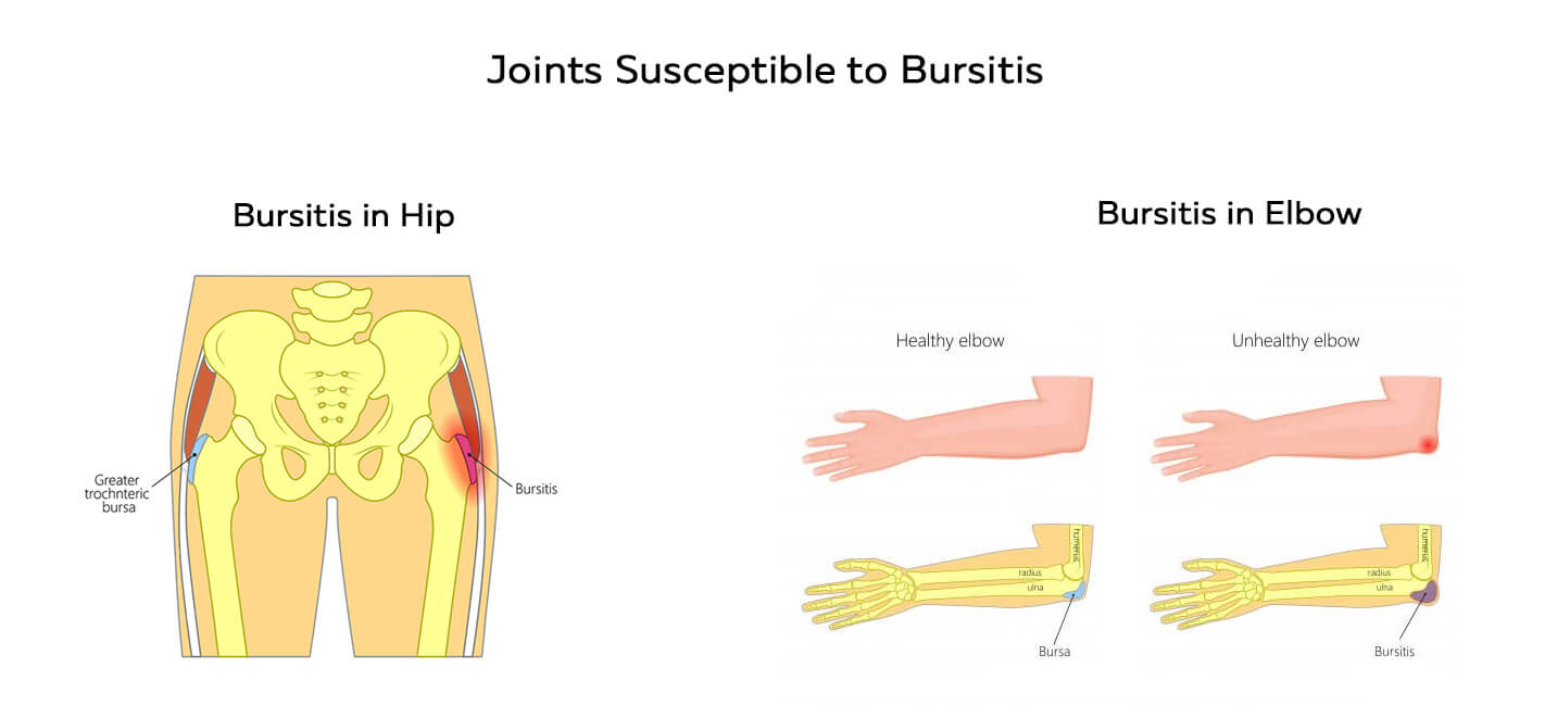 Bursitis in hip and elbow joints
