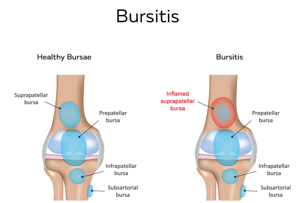 Healthy bursae and bursitis