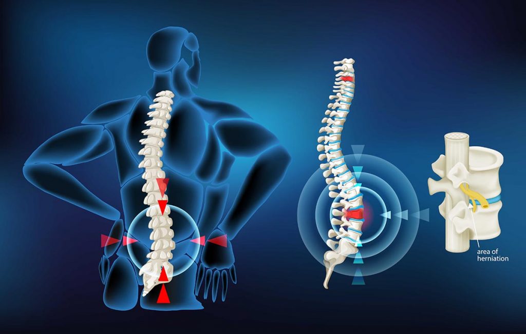 Herniated Disk