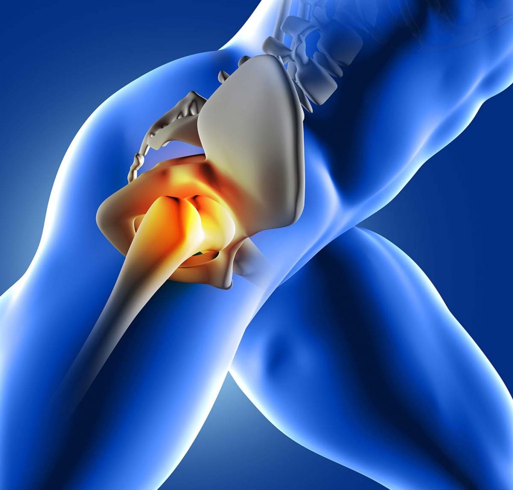 Hip Joint Arthritis