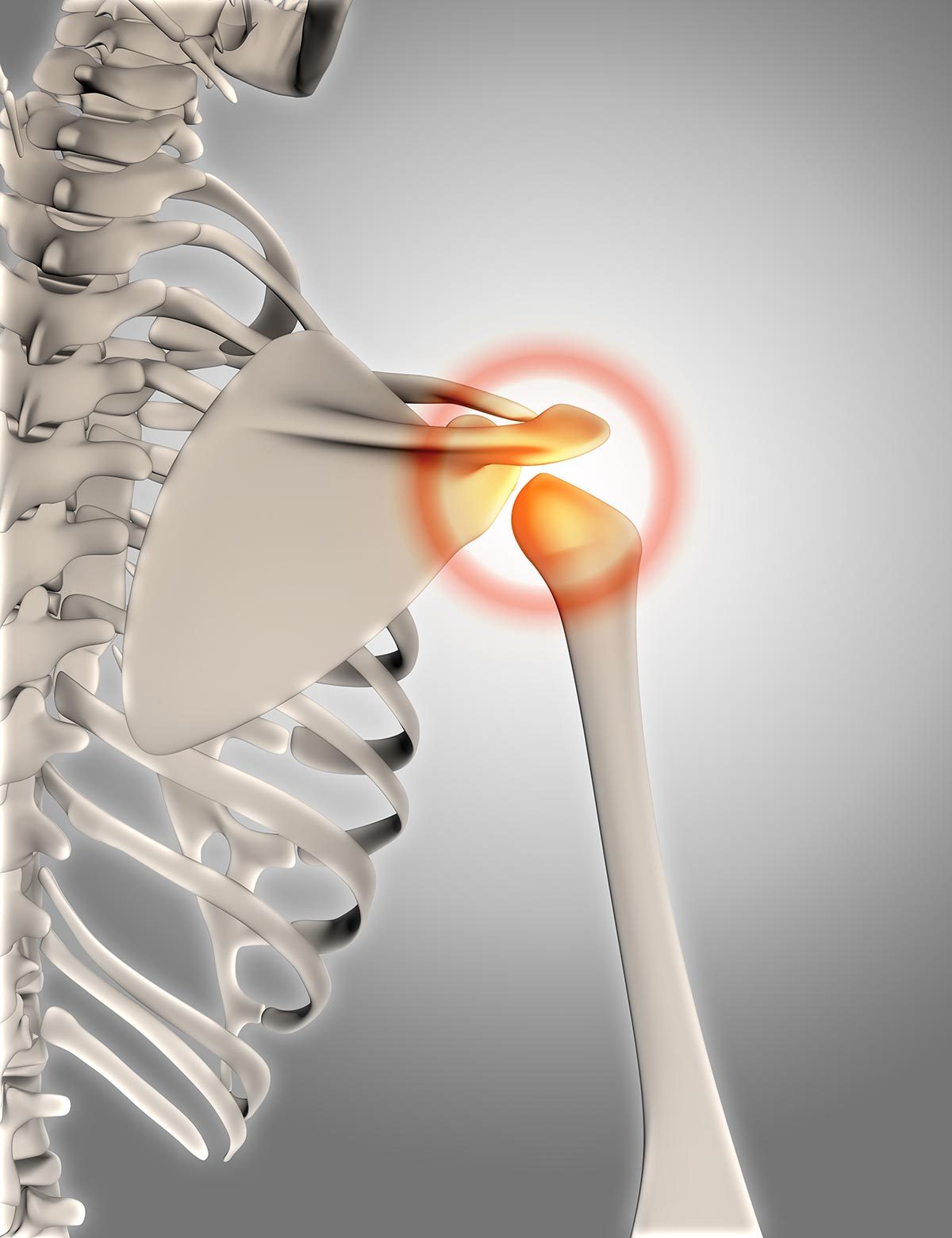 Osteoarthritis