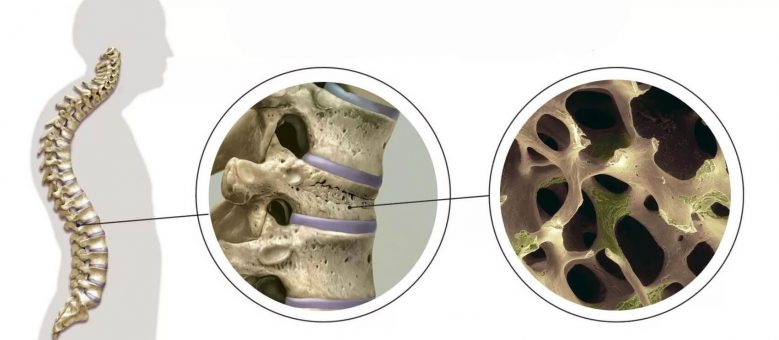 Osteoporosis