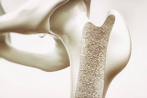 osteoporosis