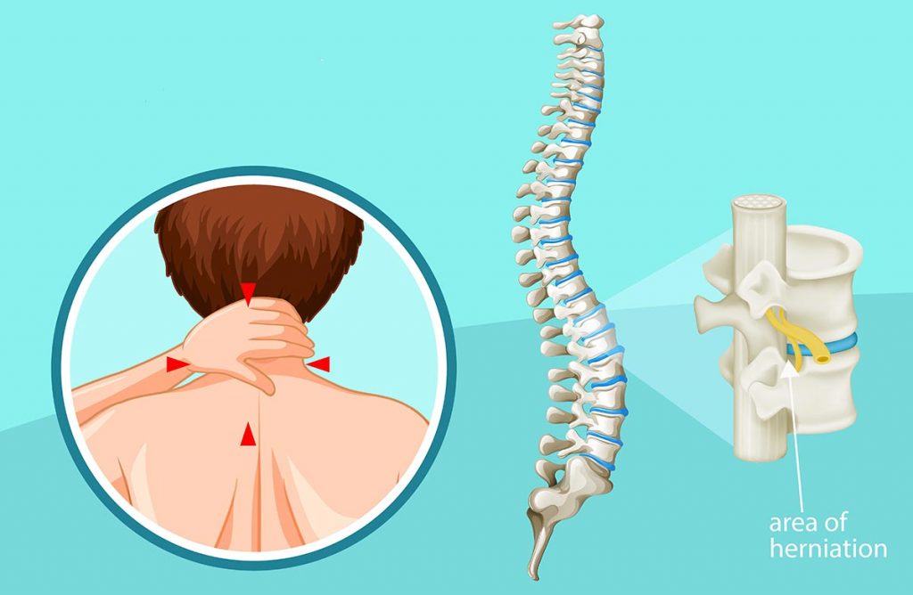 Pinched nerve in neck: Symptoms, causes, treatment, and more