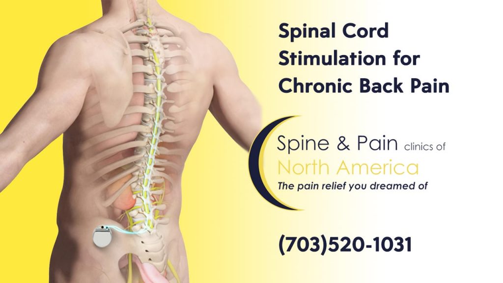 Spinal Cord Stimulation. SAPNA: Spine and Pain Clinic of North America,  Fairfax VA