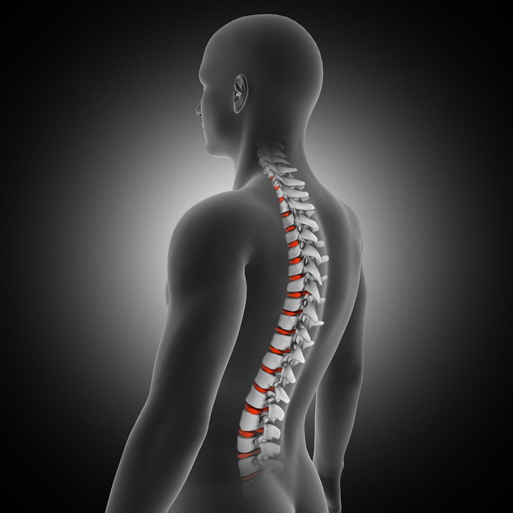 Spinal Stenosis