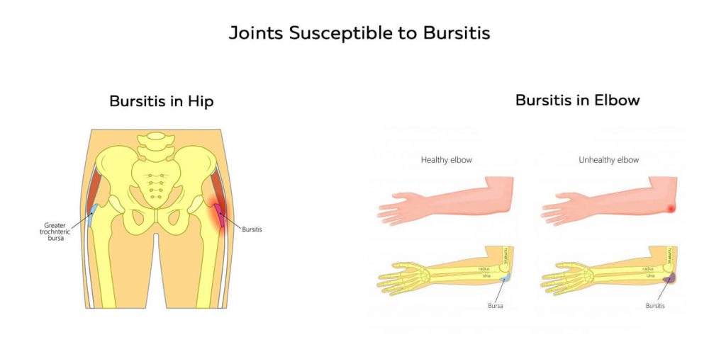 Bursitis in hip and elbow joints