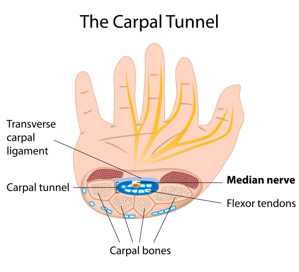 What is Carpal Tunnel Syndrome