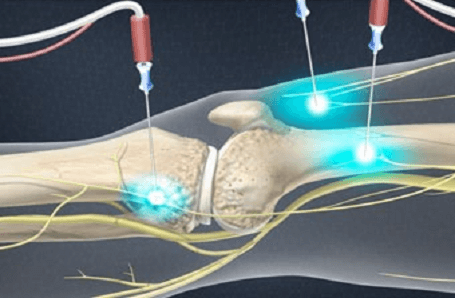 Genicular Nerve Block