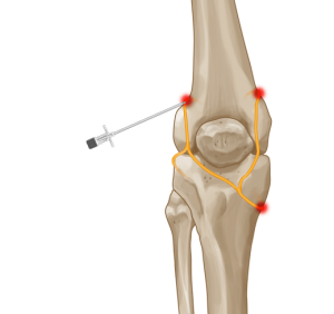 Genicular Nerve Block and Radiofrequency Ablation (GNRFA)