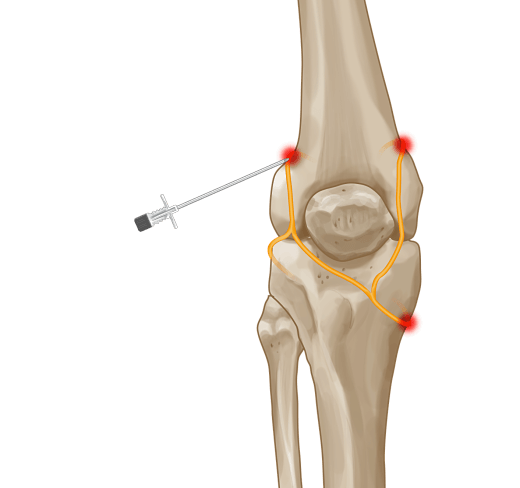 Genicular Nerve Block and Radiofrequency Ablation (GNRFA)