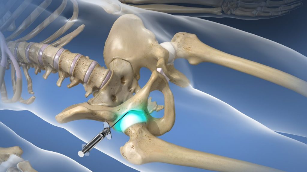 Hip joint injection