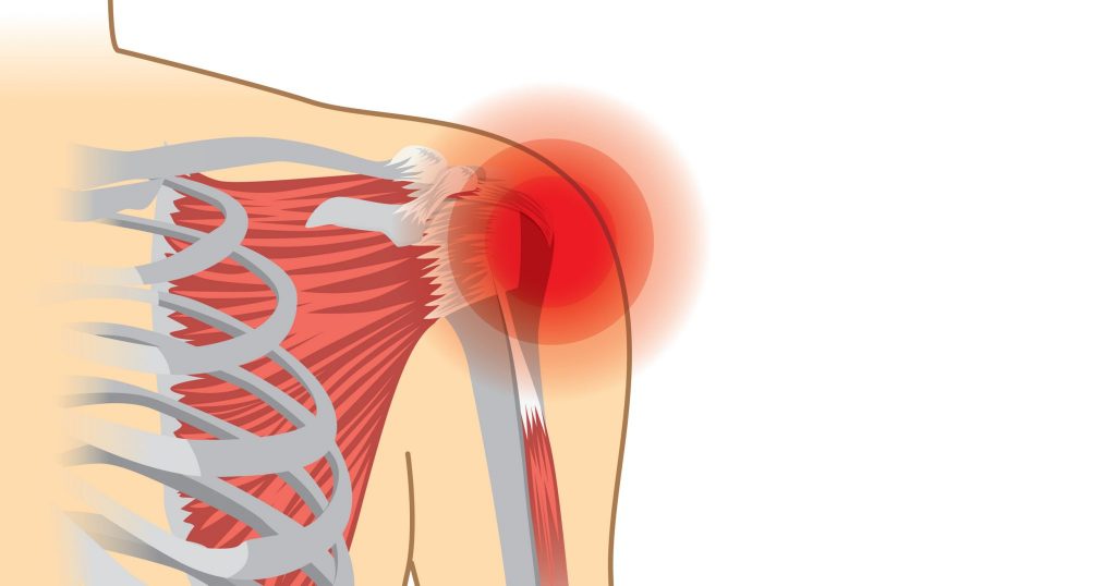 Rotator Cuff Syndrome