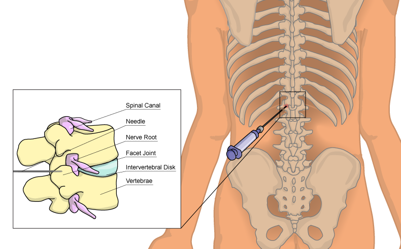 Facet joint injection