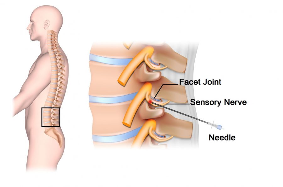 Facet Rhizotomy