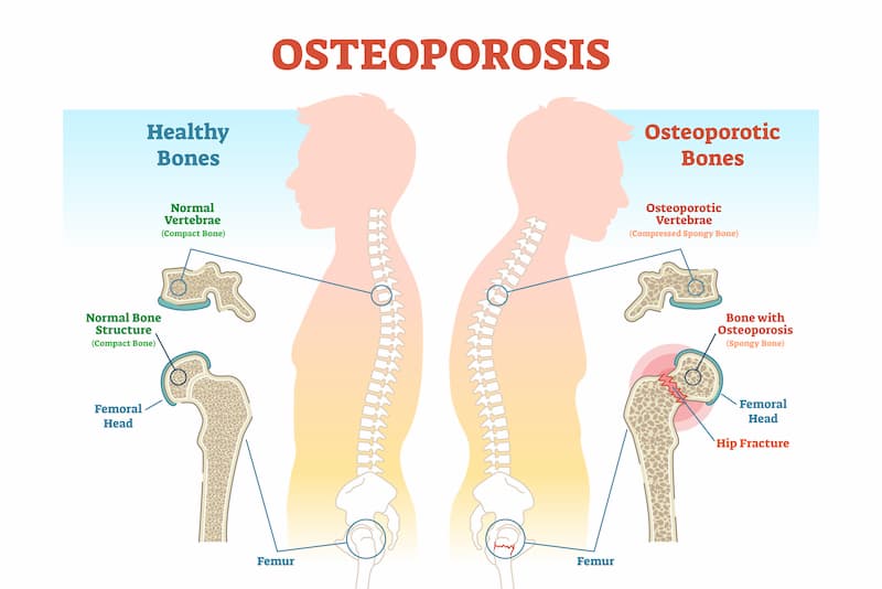 Osteoporosis infographic: healthy and osteoporotic bones