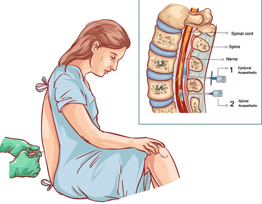 Epidural injection