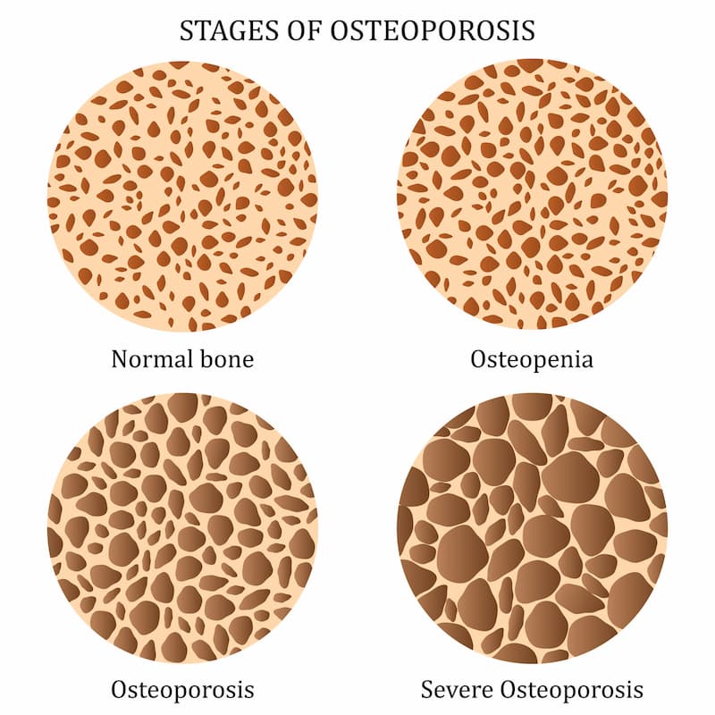 Osteoporosis stages with porous bones