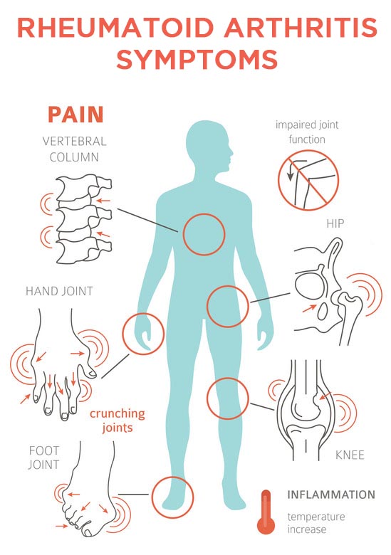 Rheumatoid Arthritis Symptoms