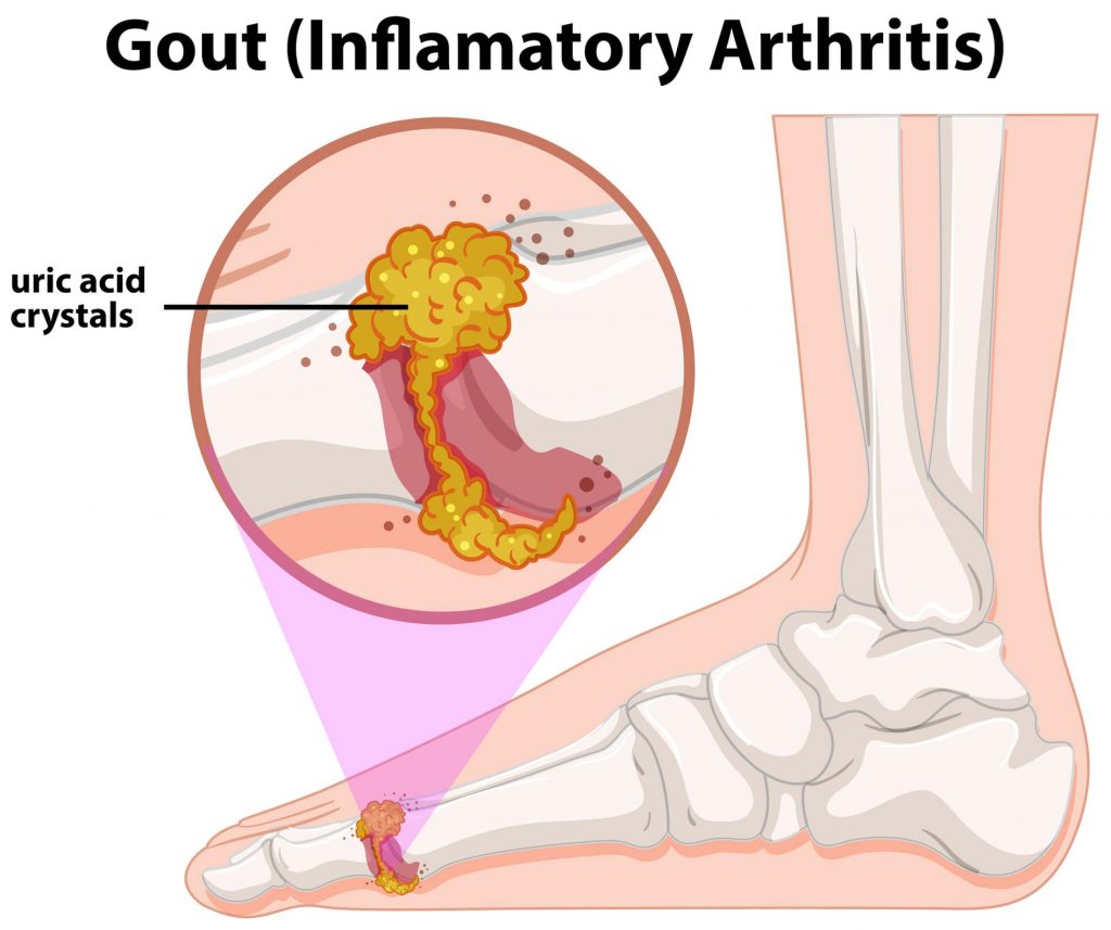 Gout