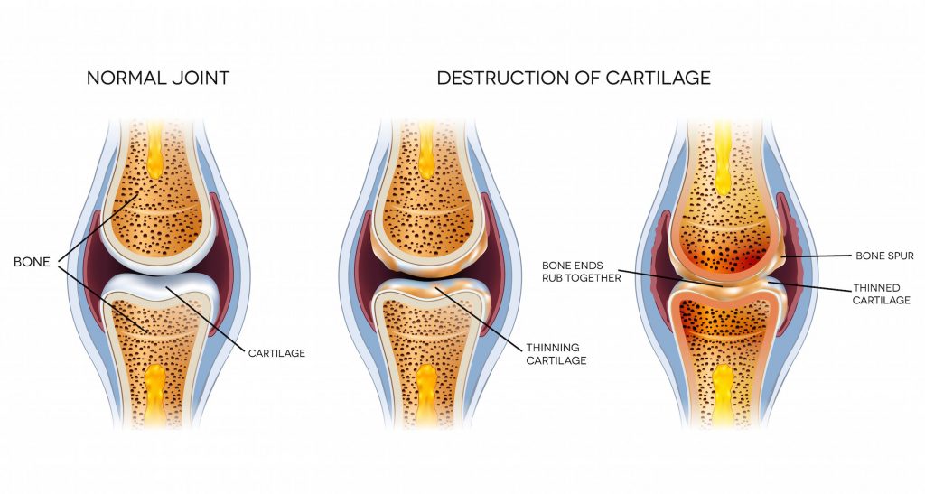 Normal joint and cartilage deterioration