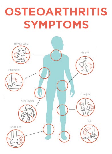 Osteoarthritis Symptoms