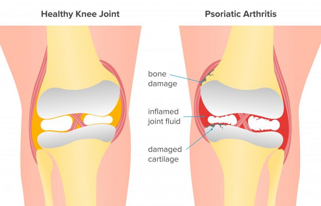 Psoriatic arthritis in the Knee