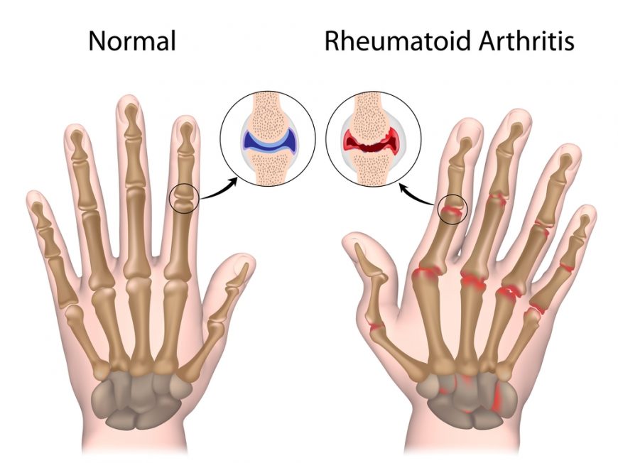 Normal joint and inflamed joint linings