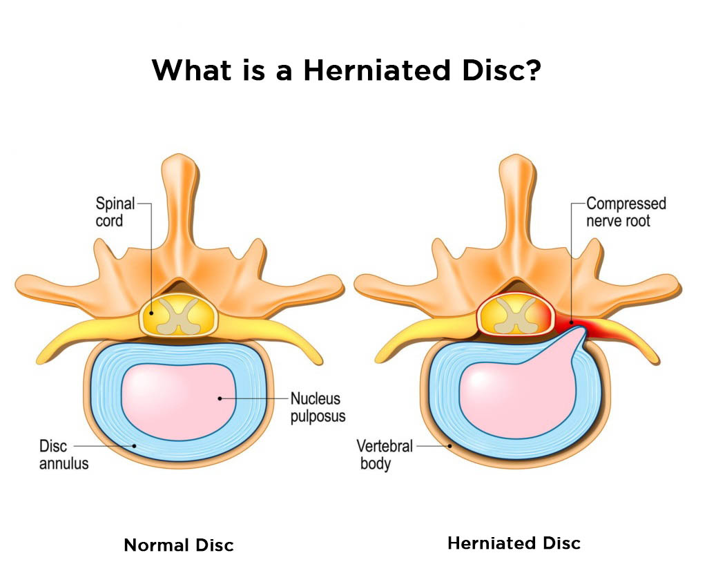 How To Prevent A Herniated Disc