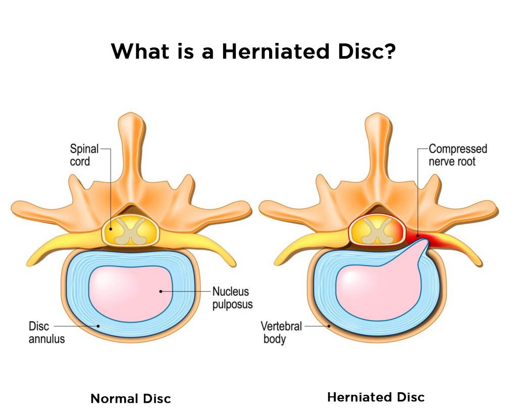 Normal and herniated discs