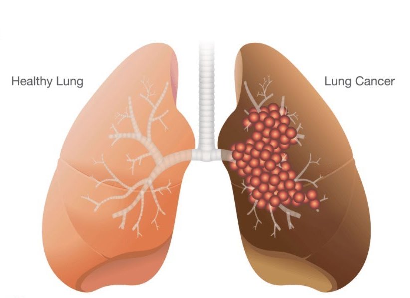 healthy-lung-lung-cancer