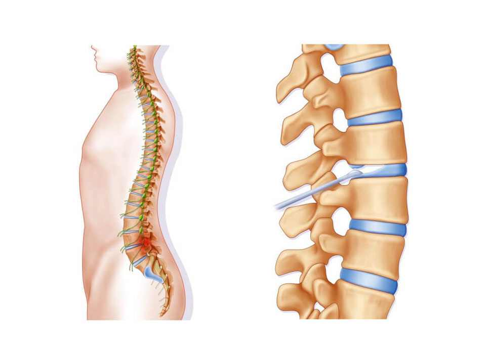 Medial Branch Nerve Blocks