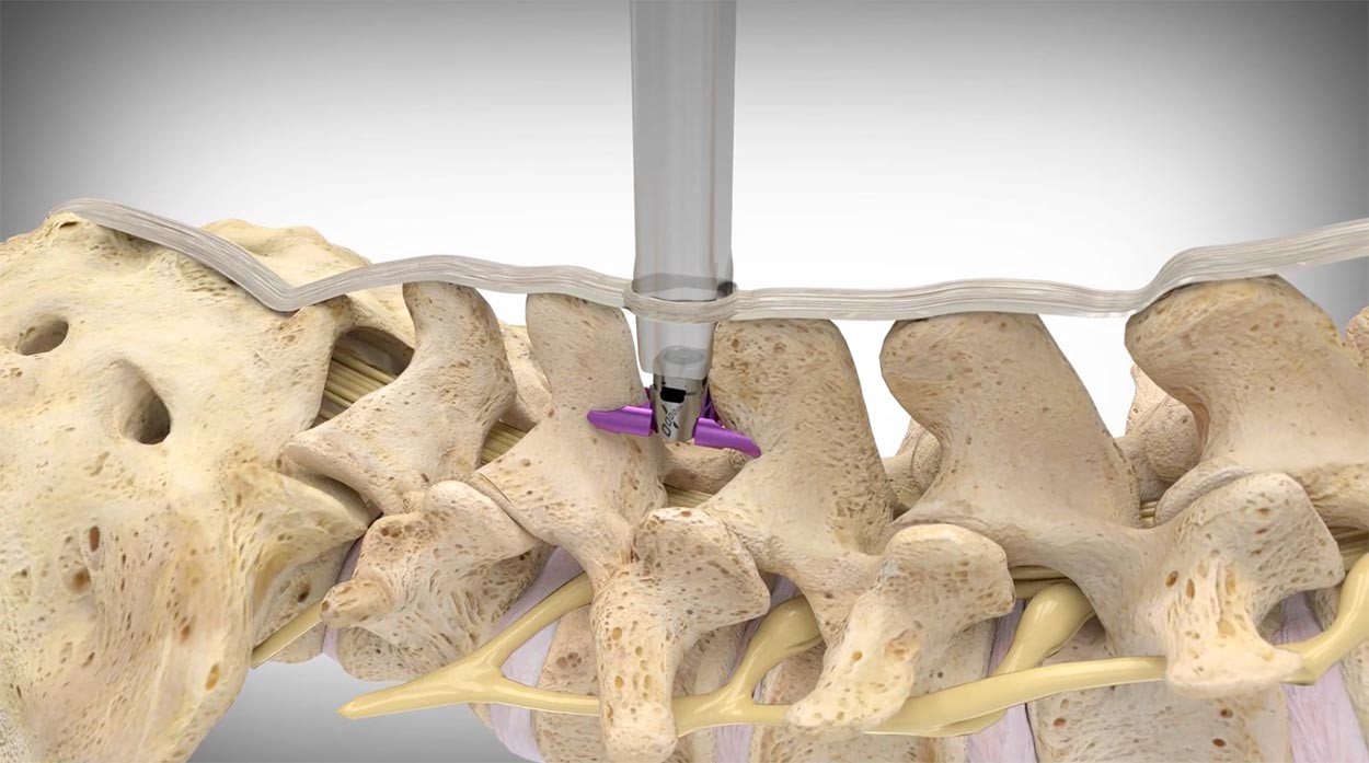 Vertiflex procedure for spinal stenosis: SAPNA: Spine and Pain Clinic of North America, Fairfax, Dulles, VA