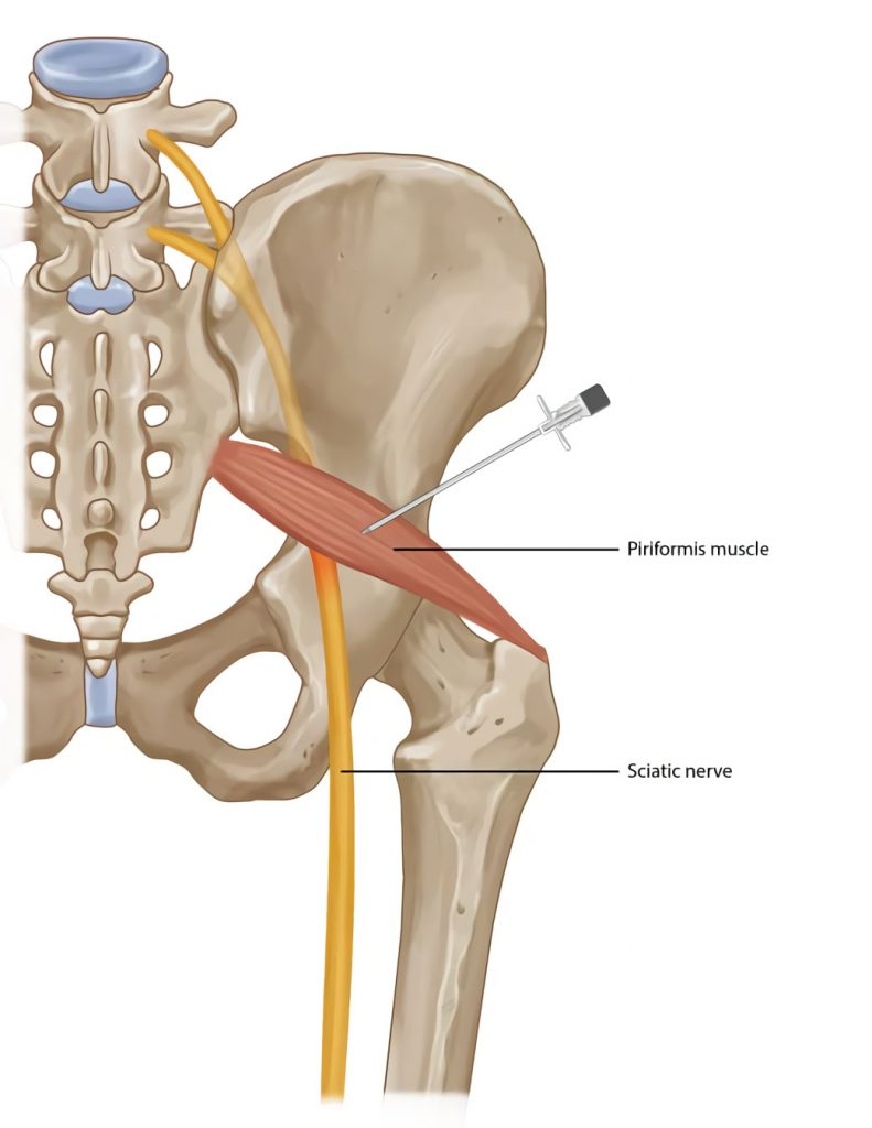 How to Heal Piriformis Syndrome Quickly