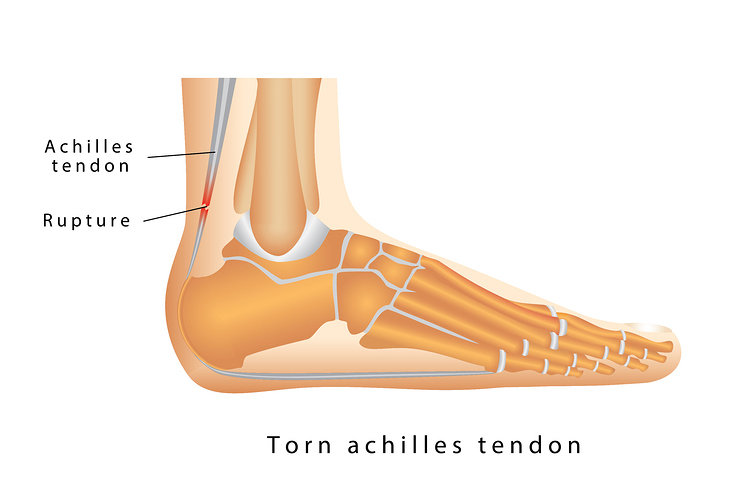 achilles tendon rupture