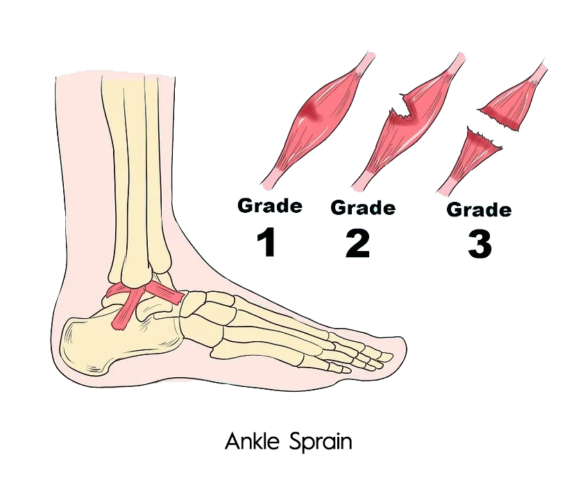 What Causes Heel Pain? SAPNA Spine and Pain Clinic of North America