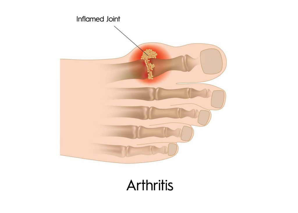 arthritis