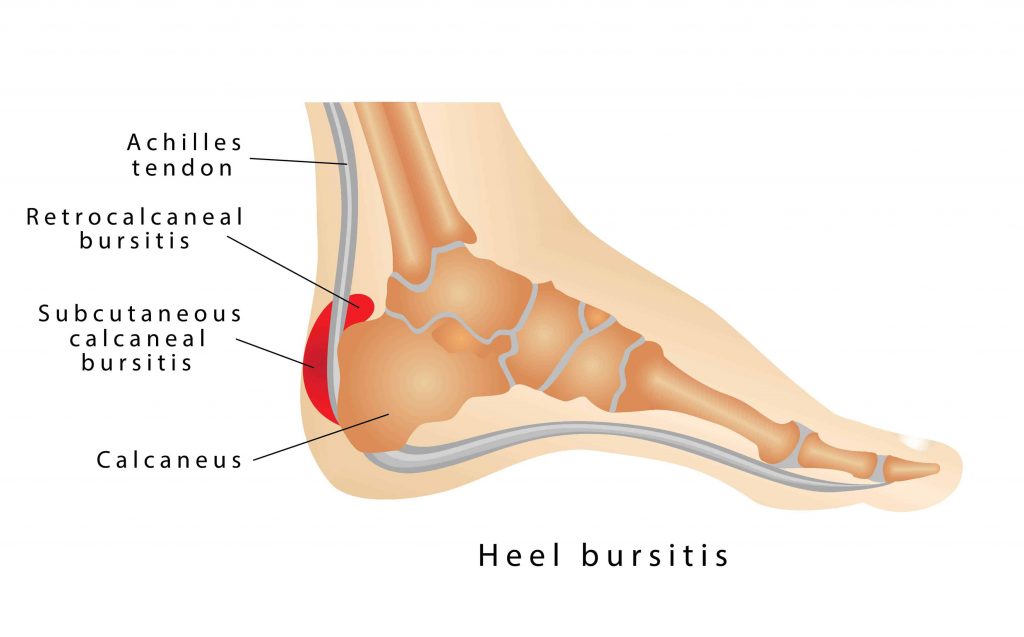 heel bursitis