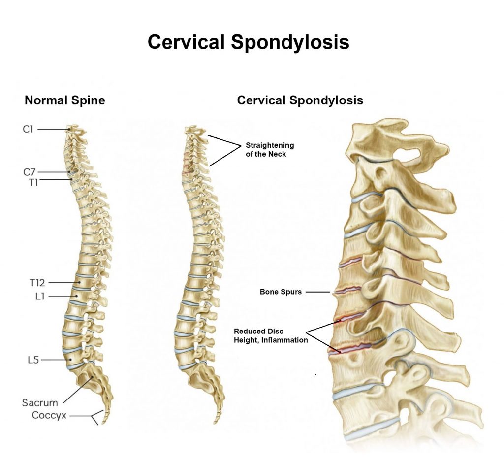 cervical spine spondylosis