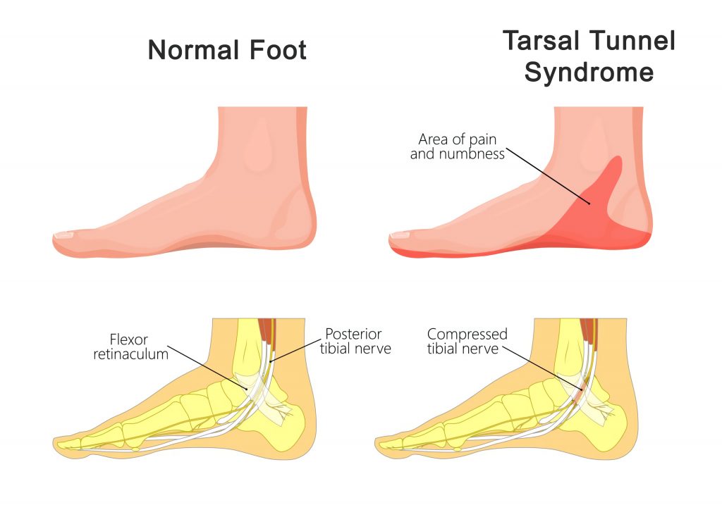 normal foot tarsal tunnel syndrome sapnamed.com